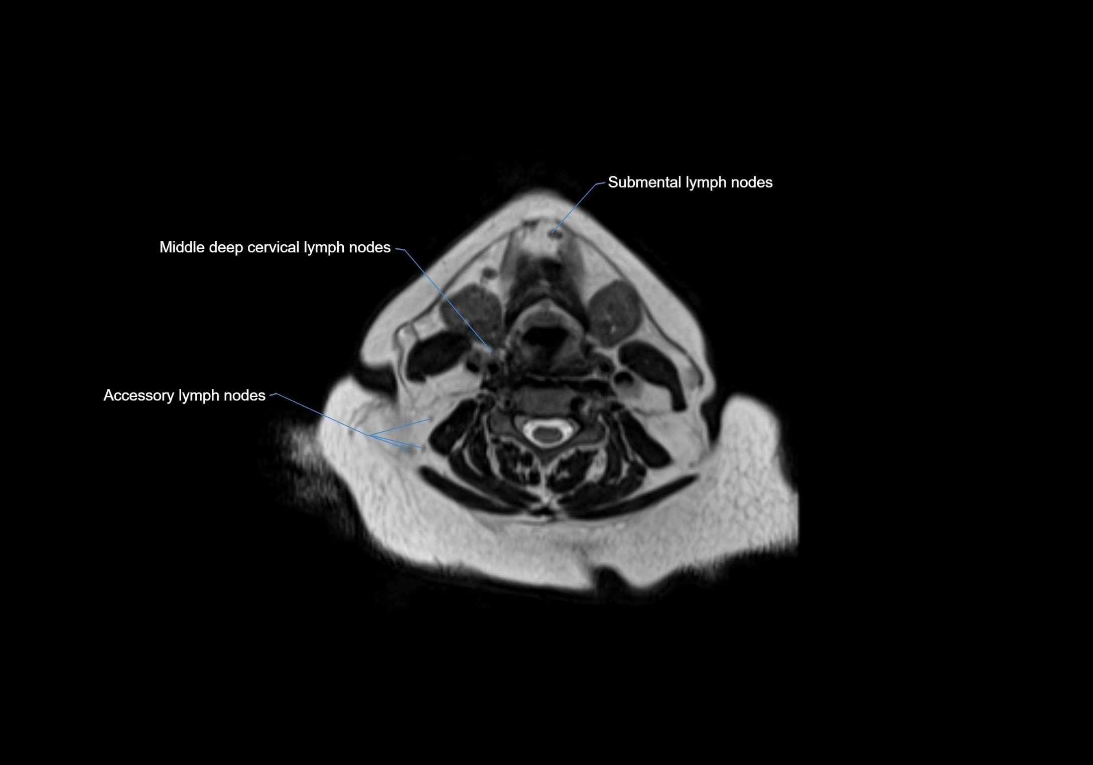 Neck axial  lymph node cross sectional MRI anatomy 3T MRI  image-img-00001-00058.webp